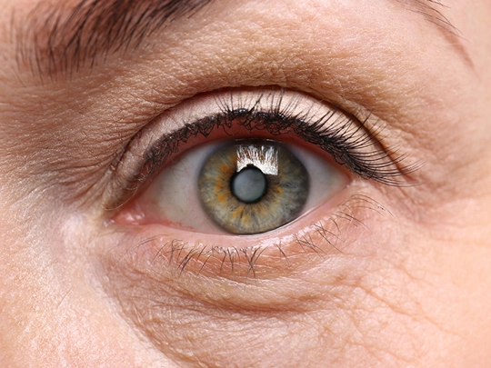 Cataract