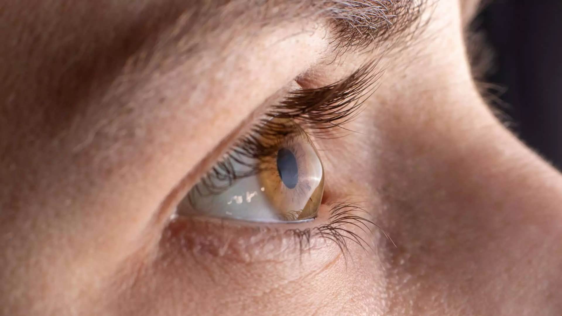 Corneal Diseases