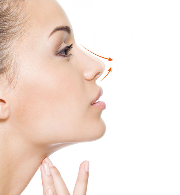 Nose Filling