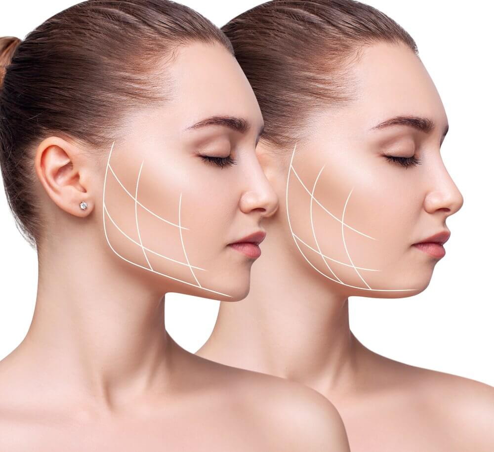 Jawline Filling