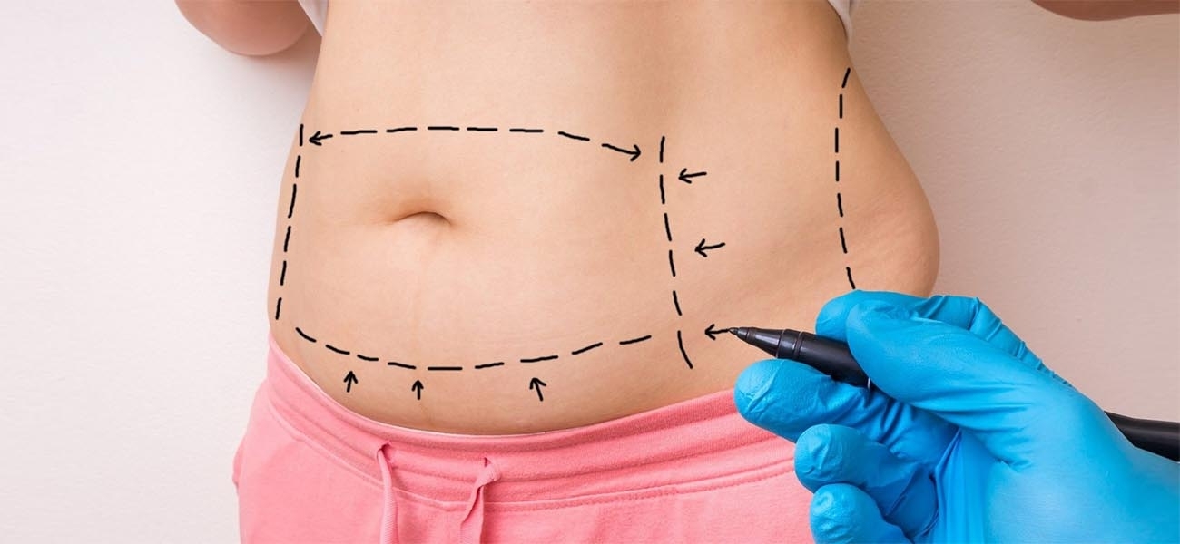 Abdominoplasty