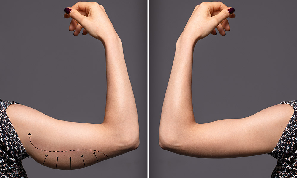 Arm Lift