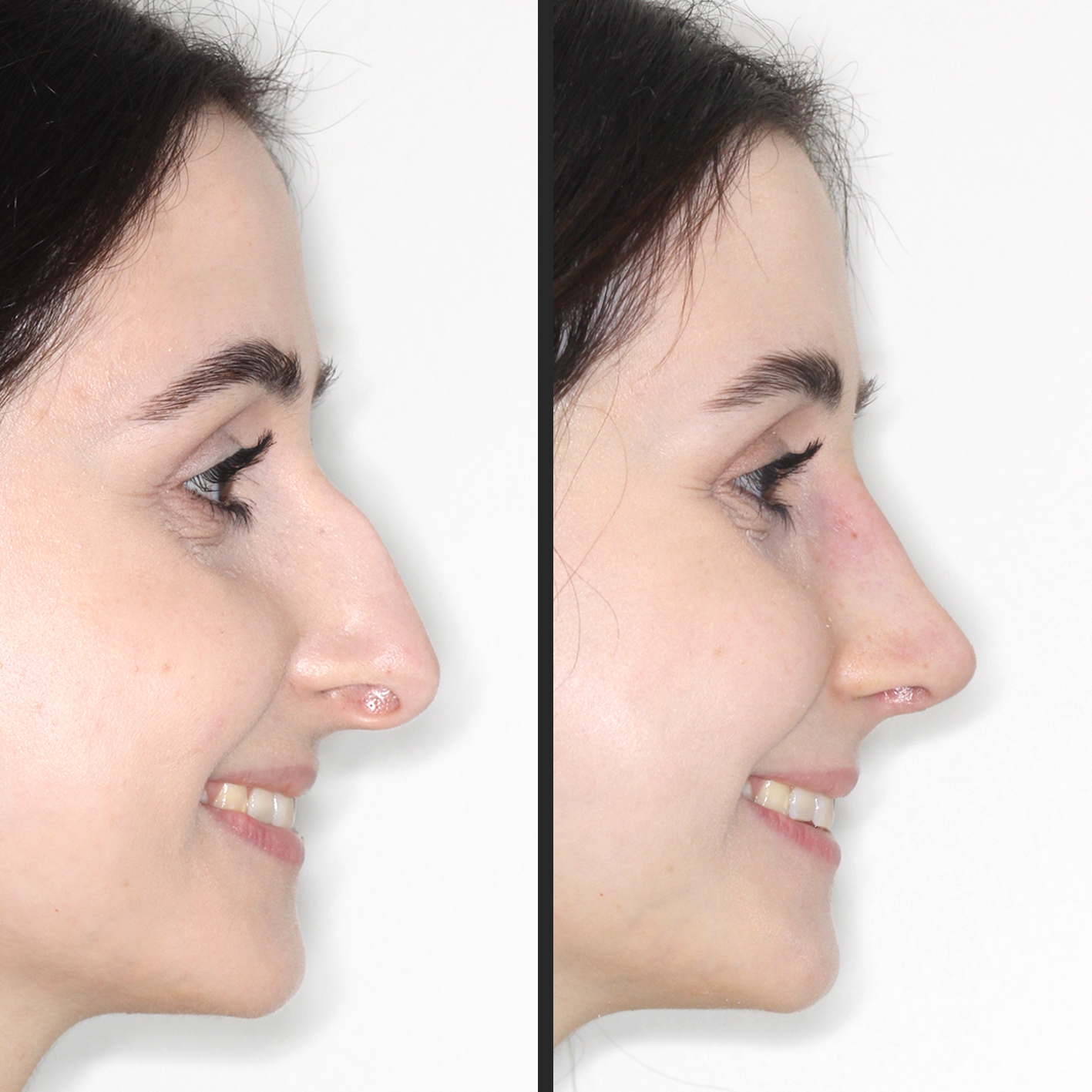 Rhinoplasty