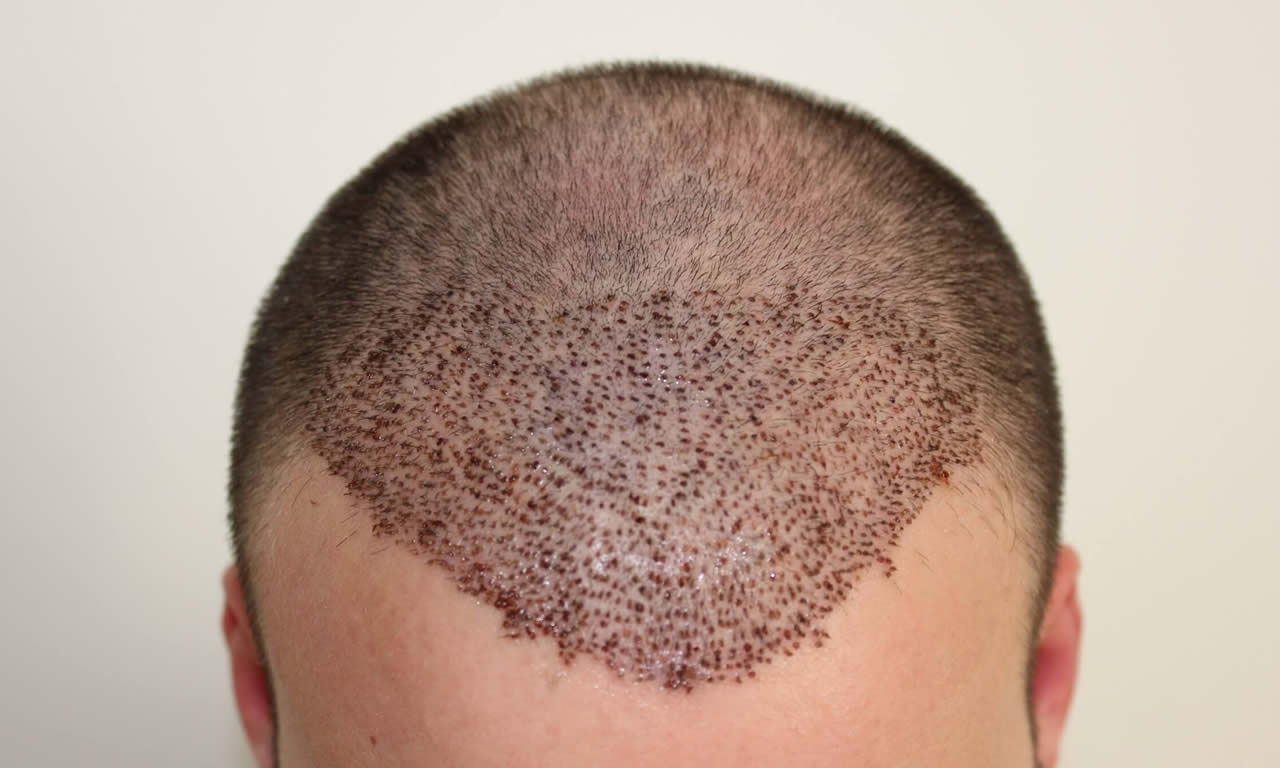 DHI Hair Transplantation