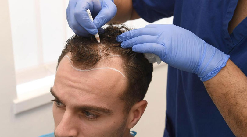 Stem Cell Hair Treatment